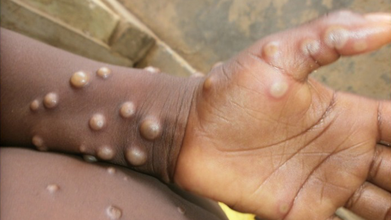 Monkeypox – an emerging global health threat